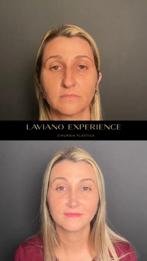 Antes e depois feminino  - 6
