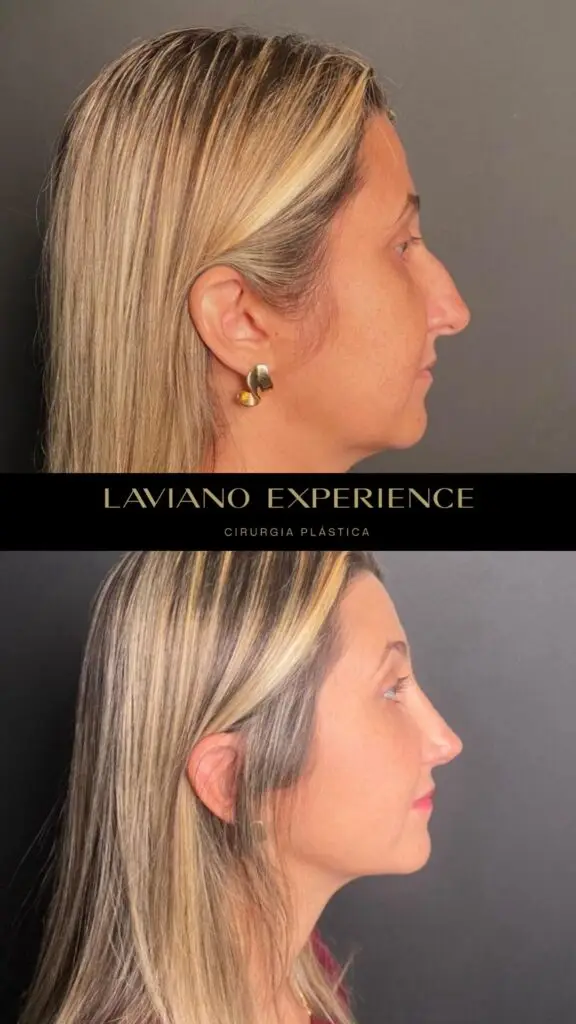 Antes e depois feminino  - 5