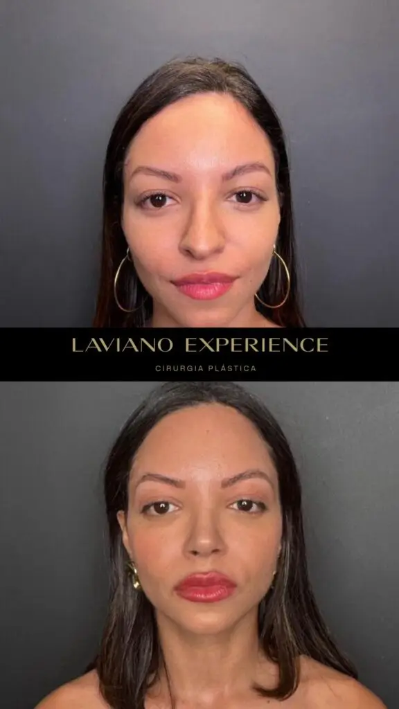 Antes e depois feminino  - 7