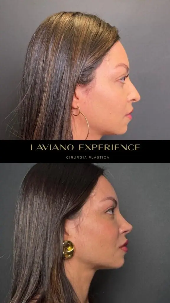 Antes e depois feminino  - 8