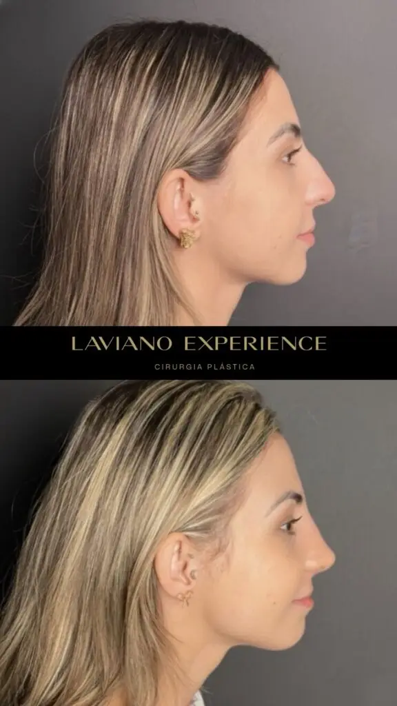 Antes e depois feminino  - 10